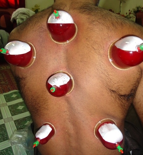 Hijama for frozen shoulder