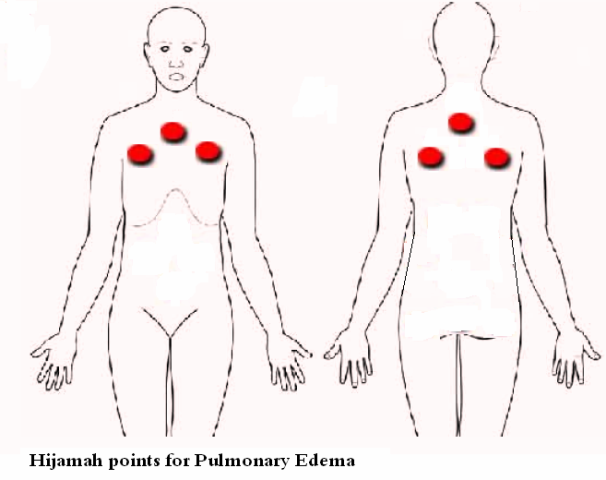 Hijamah points for Pulmonary Edema